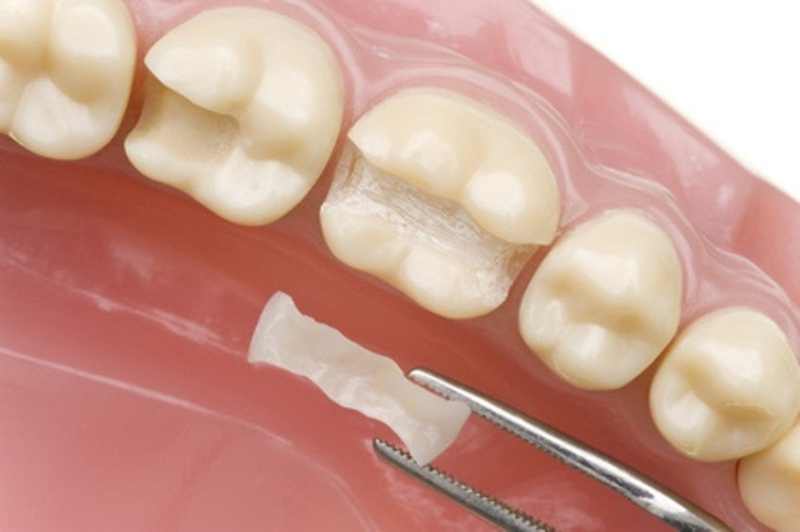 نوعی از ترمیم و در واقع پر کردن دندان است که سه سطح از دندان را در بر گرفته 